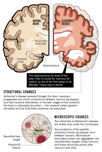 Age-Related Brain Diseases: 17 Risk Factors Revealed