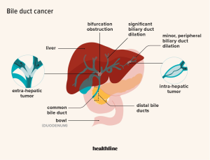 Bile Imbalance & Liver Cancer: Key Insights for Treatment